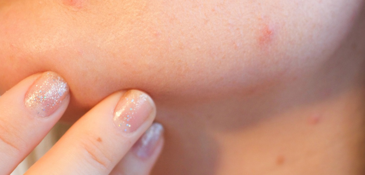 Nonacne - poznaj 6 przyczyn trądziku