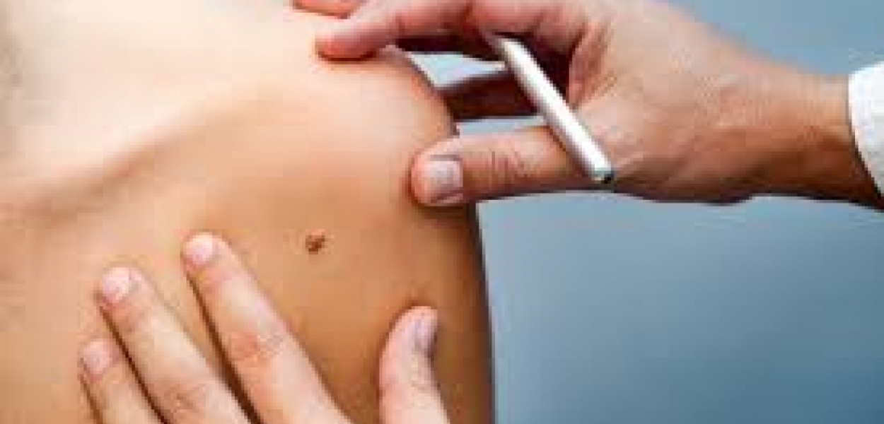 Usuwanie znamion - na co uważać?